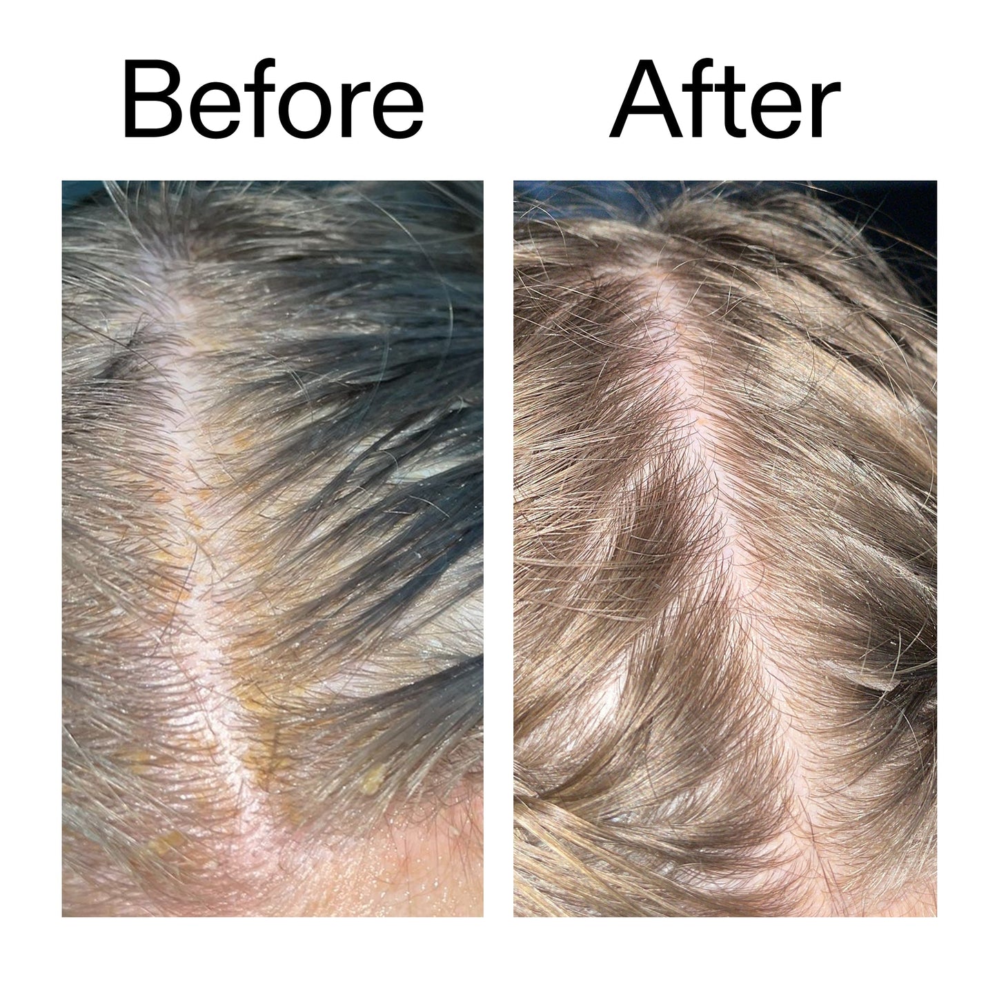 salicylic-acid-exfoliating-scalp-treatment-k9 Salicylic_Acid_Exfoliating_Scalp_Treatment_Before_After_2000x2000_e572a30f-057c-4a48-823b-1c09dc97f8d0.jpg