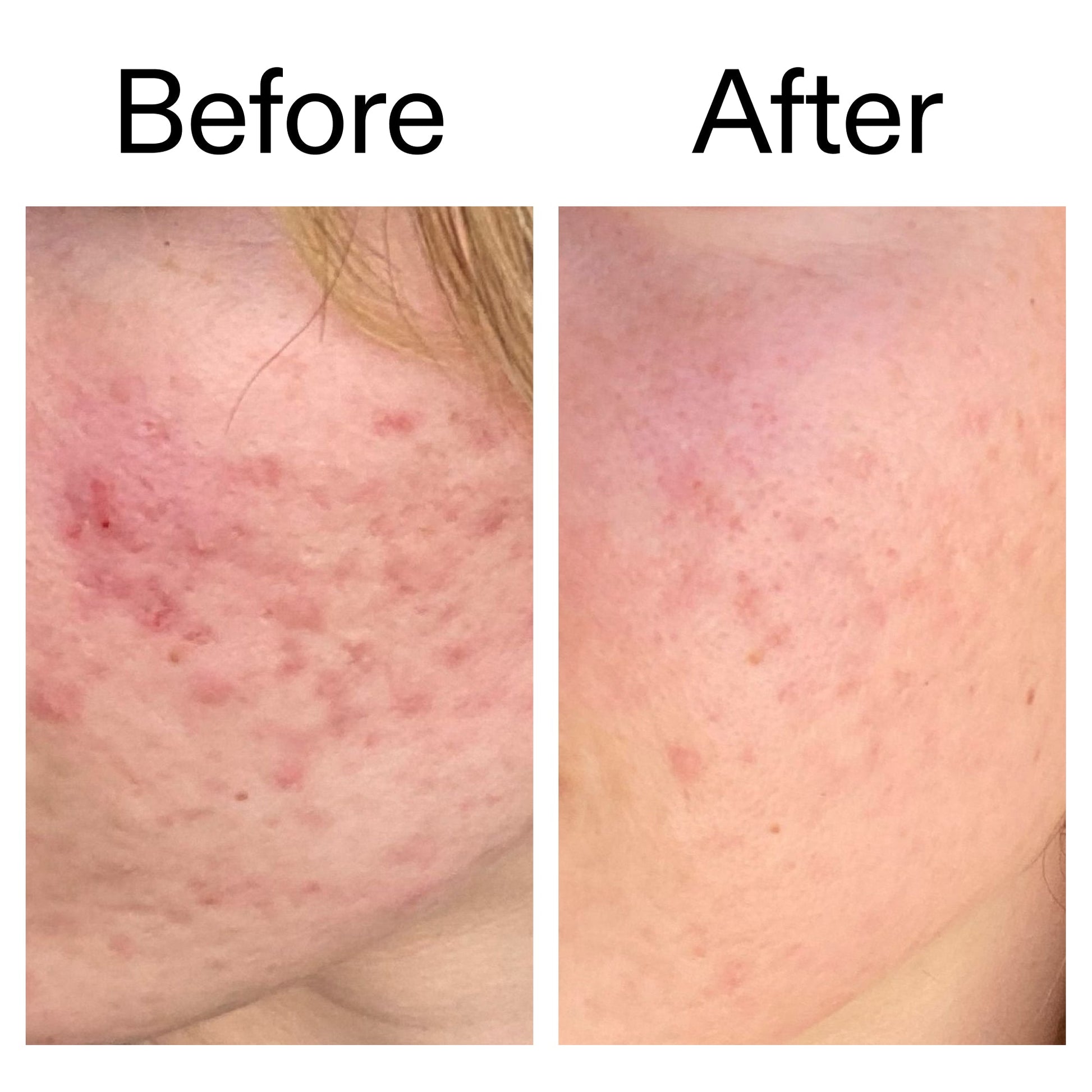 10-azelaic-acid-serum-for-redness-relief-w6 Azealic_Acid_Serum_B_A_Ppage_2000_x_2000.jpg