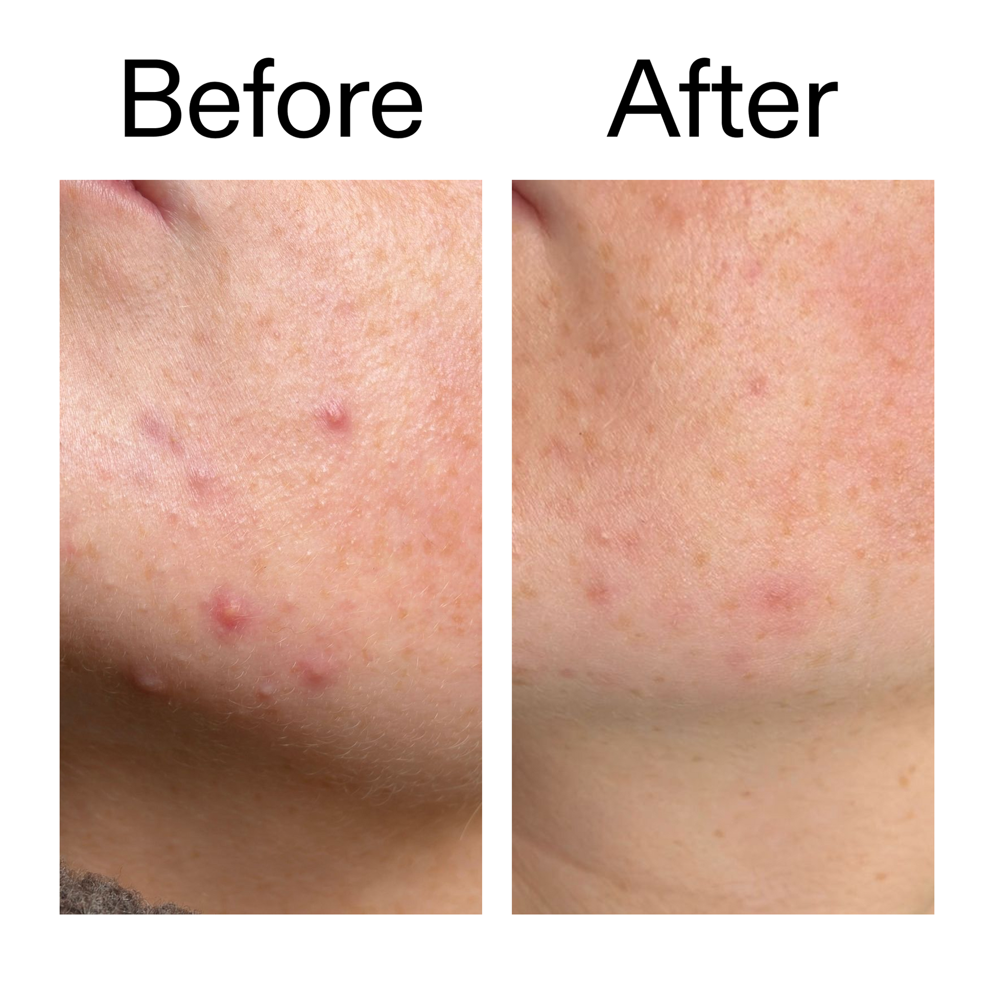 10-azelaic-acid-serum-for-redness-relief-w6 B_A_1_PPAGE.png