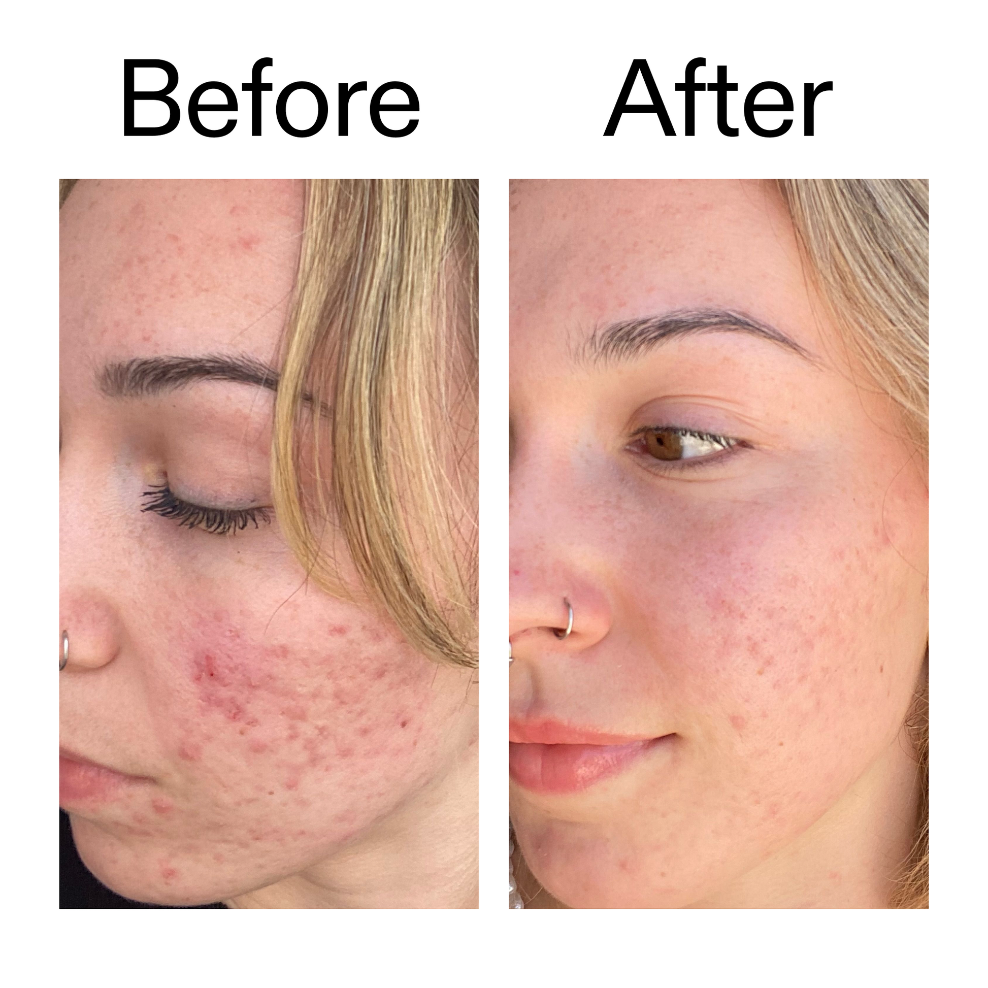 10-azelaic-acid-serum-for-redness-relief-w6 B_A_2_PPAGE.png