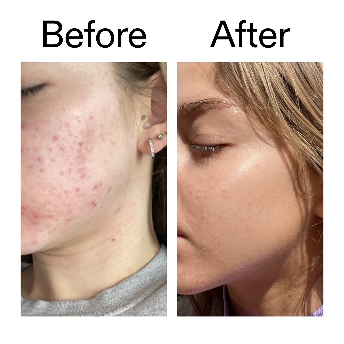 beta-hydroxy-acid-bha-serum-j4 Beta_Hydroxy_Acid_Serum_Before_After_2000x2000_96fda3e5-938d-49ef-bcf2-a0fa6ece4e2c.jpg