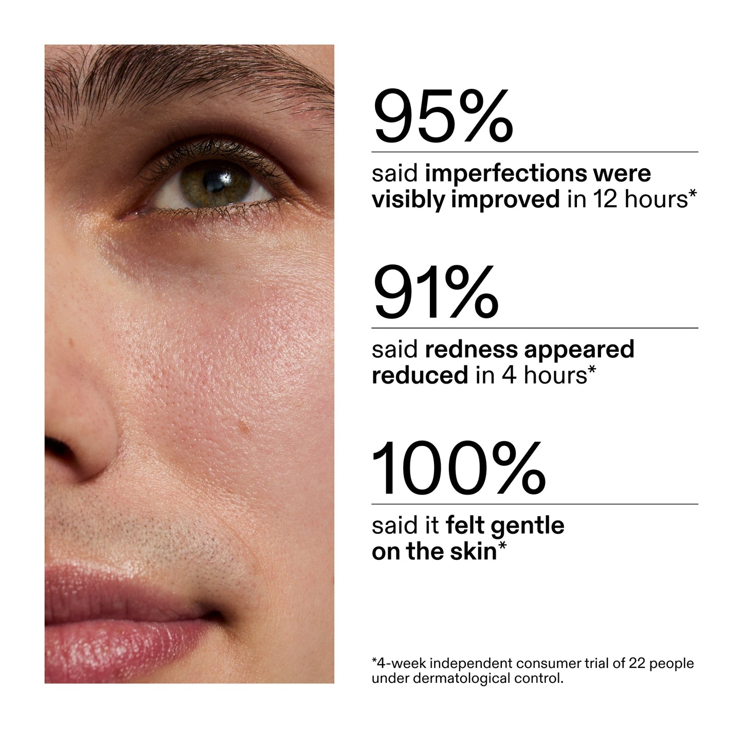 succinic-acid-acne-treatment-m1 CA_Succinic_Acid_Treatment_key_Claims_2000x2000_db91b0f1-7f29-4bfe-bb16-63a47f500960.jpg