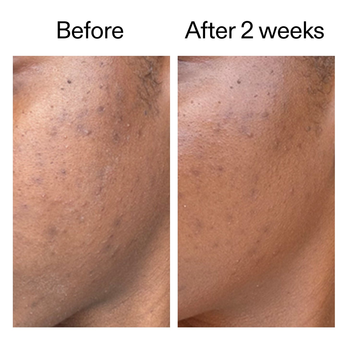 360-acne-clearing-duo-p7 DIOICB_A2000x2000.jpg