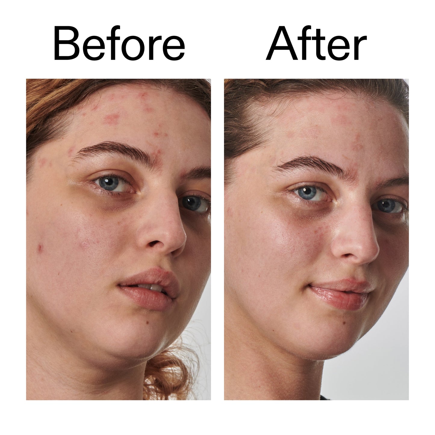 10-urea-moisturizer-o3 Dry_and_Rough_Skin_Solution_Before_After_2000x2000_efa6e639-5c39-49bd-a5dd-f0220293120a.jpg