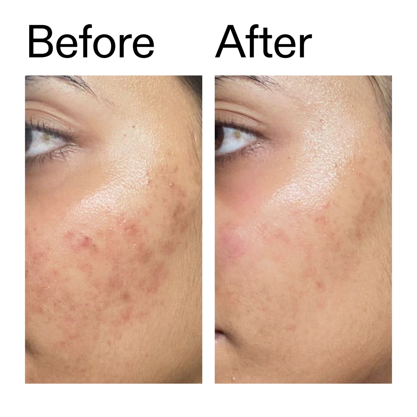 ectoin-hydro-barrier-serum-u7 Ectoin_Hydro-barrier_Serum__Before_After_2000x2000_34261920-d004-48d0-9c7b-8e1c15971bfd.jpg