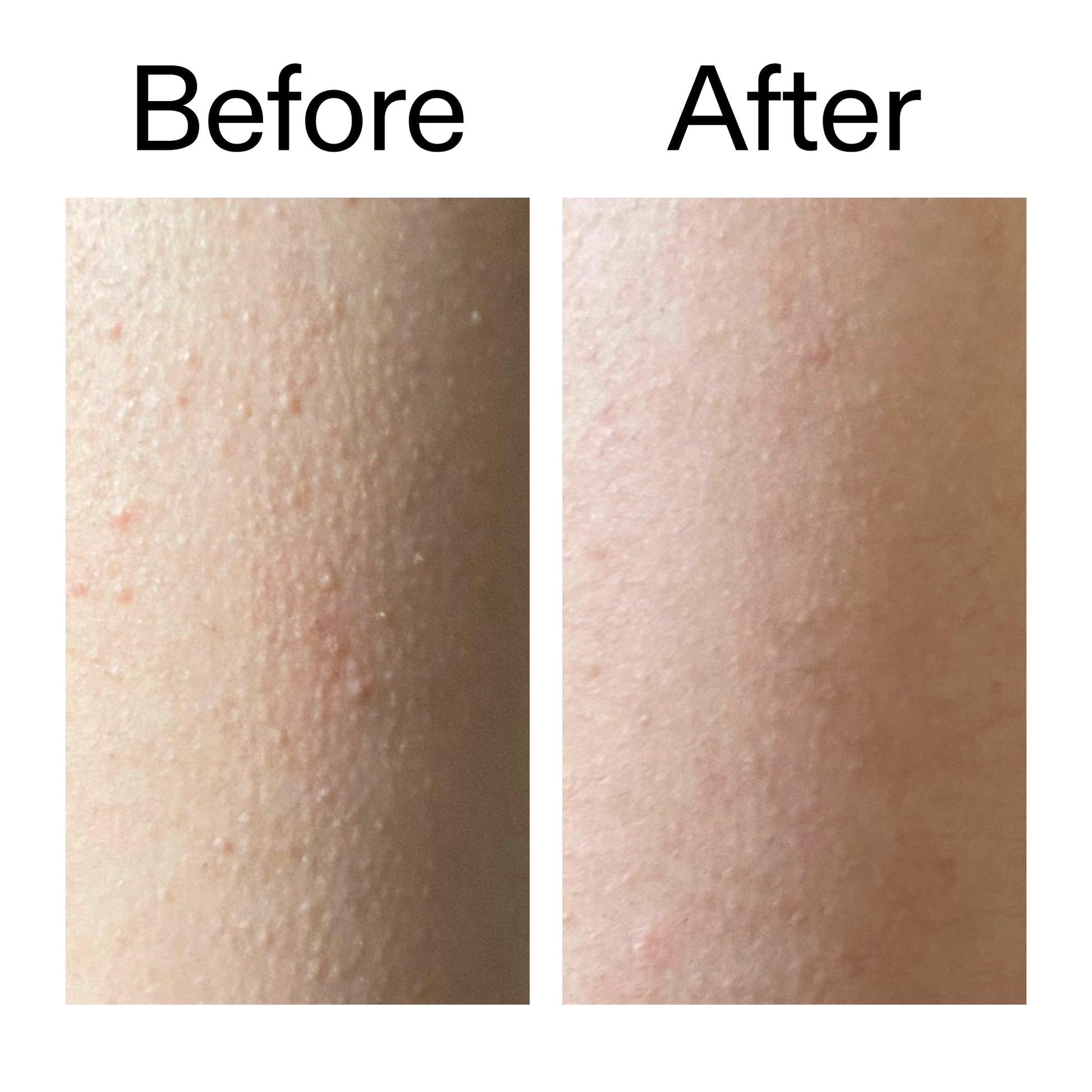 glycolic-acid-exfoliating-body-stick-duo-u7 Glycolic_Acid_Exfoliating_Body_Stick_Before_After_V2_2000x2000_2e4ba052-94f6-4d56-82df-7bdb5b2df7ae.jpg