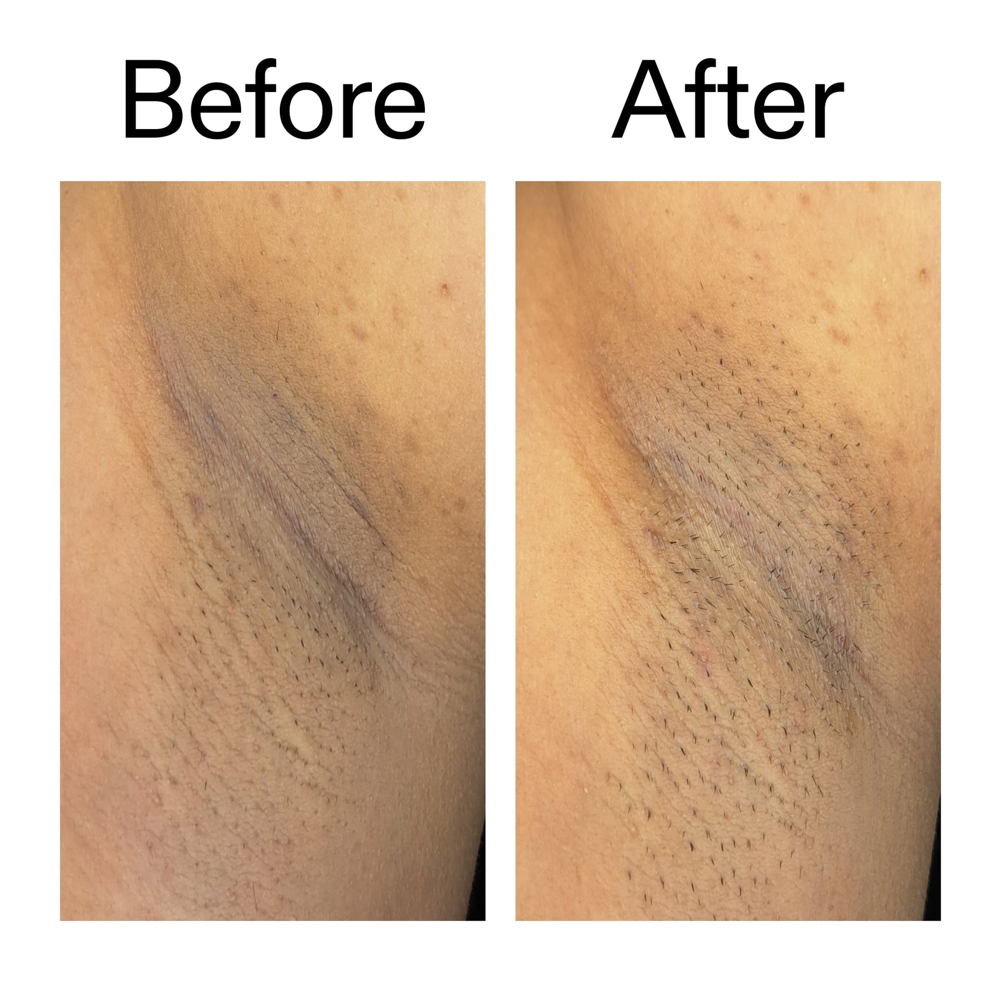 glycolic-acid-exfoliating-body-stick-duo-u7 Glycolic_Acid_Exfoliating_Body_Stick_Before_After_V3_2000x2000_ea919cd9-1439-4a46-82a0-76200eb5bb42.jpg