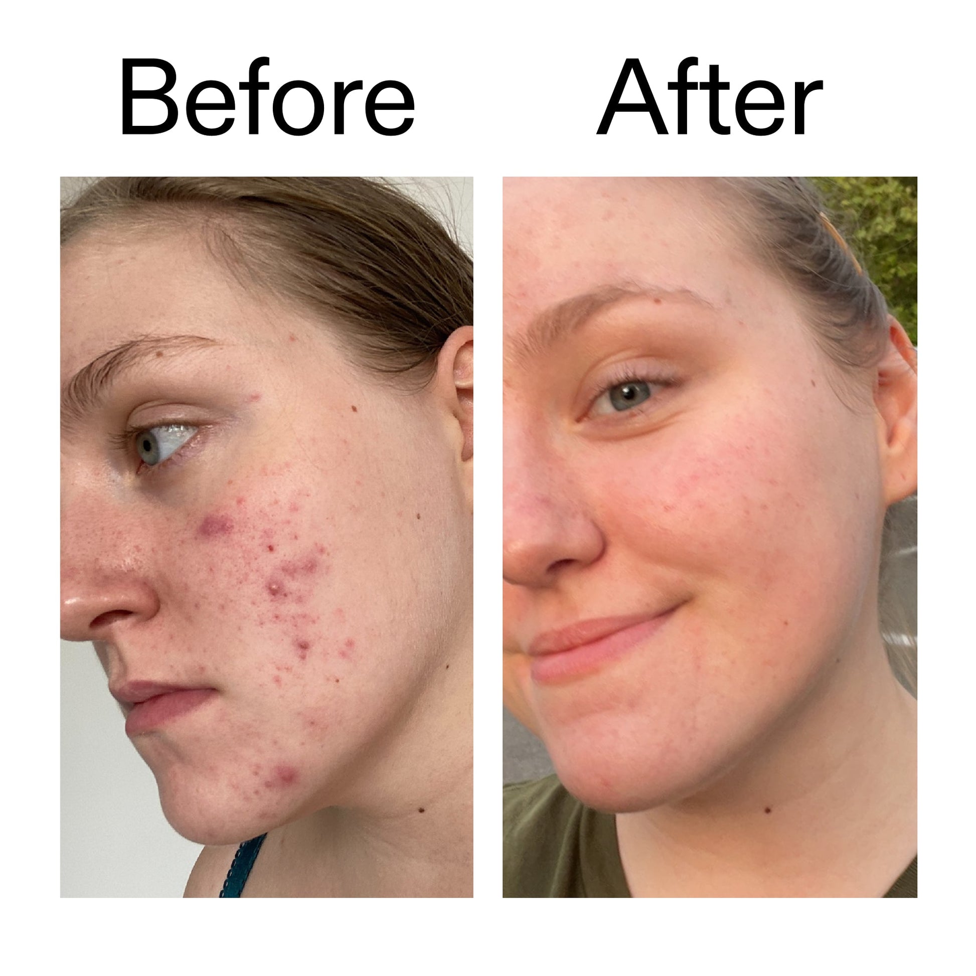 glycolic-acid-toner-a8 Glycolic_Acid_Toner_Before_After_2000x2000_49f0b9f7-e71b-4b2e-a8f8-2ea4b73247bb.jpg