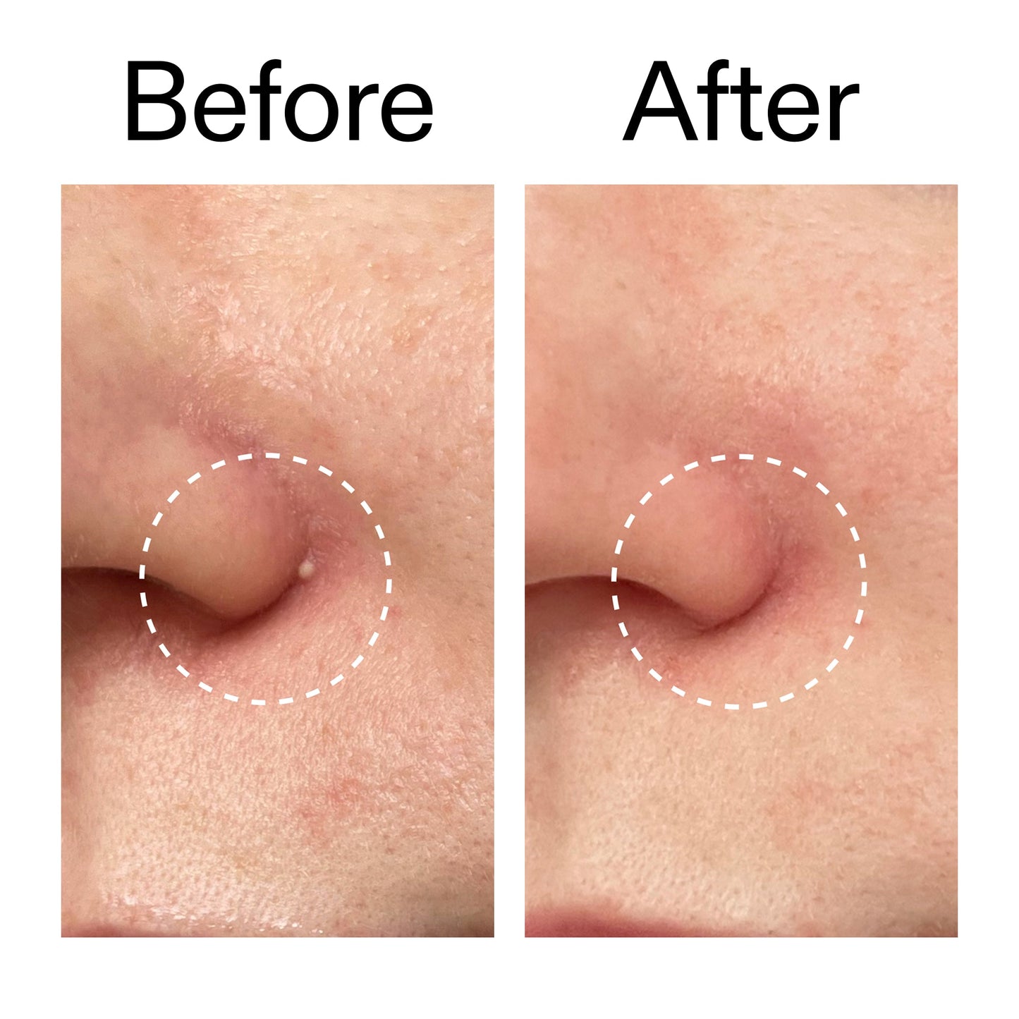 hydrocolloid-invisible-pimple-patches-pack-of-44-l3 Hydrocolloid_Invisible_Pimple_Patches_Before_After_2000x2000_b02aa37b-c78a-4682-91de-9135af5bb7df.jpg
