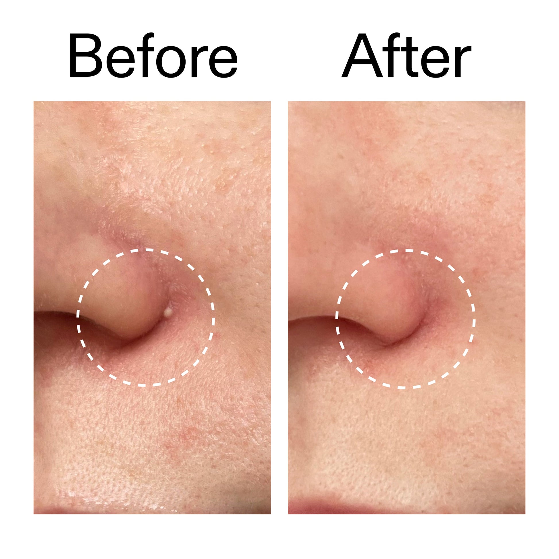 hydrocolloid-invisible-pimple-patches-pack-of-44-l3 Hydrocolloid_Invisible_Pimple_Patches_Before_After_2000x2000_b02aa37b-c78a-4682-91de-9135af5bb7df.jpg