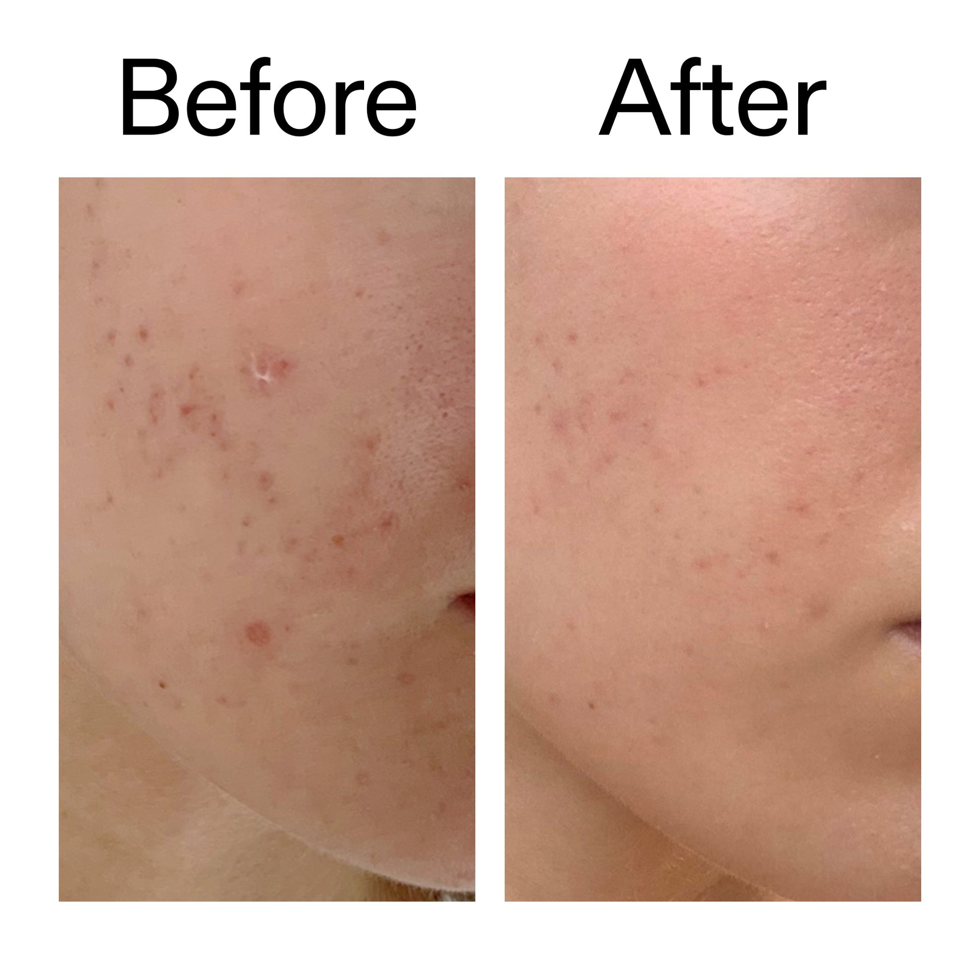 mandelic-acid-treatment-a0 Mandelic_Acid_Treatment_Before_After_2000x2000_4885ac6e-c5d7-4279-a72a-1417af7dce35.jpg