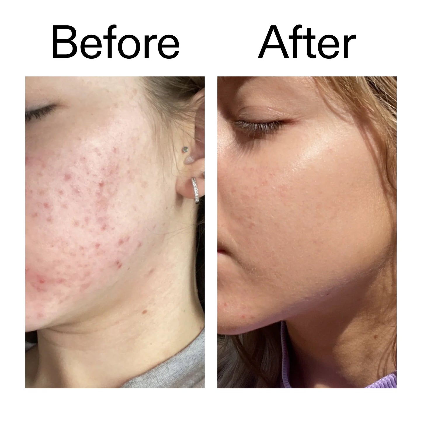 10-niacinamide-serum-duo-z6 Niacinamide_Serum_Before_After_2000x2000_bde32455-9e7d-448e-b053-bef41504f0a9.jpg
