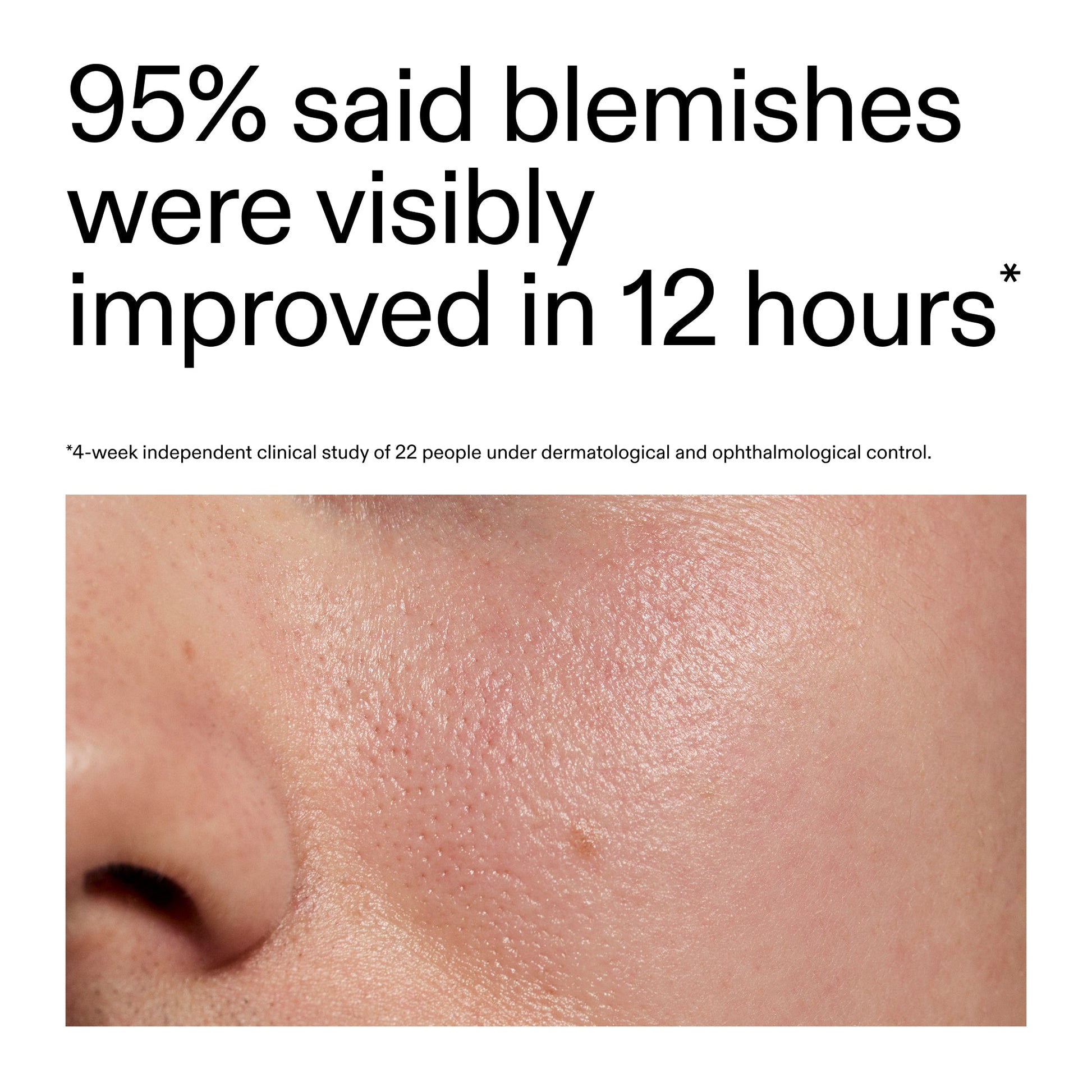succinic-acid-acne-treatment-m1 Oat_Cleansing_Balm_Claim_2000x2000_ac6ce553-25db-41b2-a981-faae1ac4b8c0.jpg