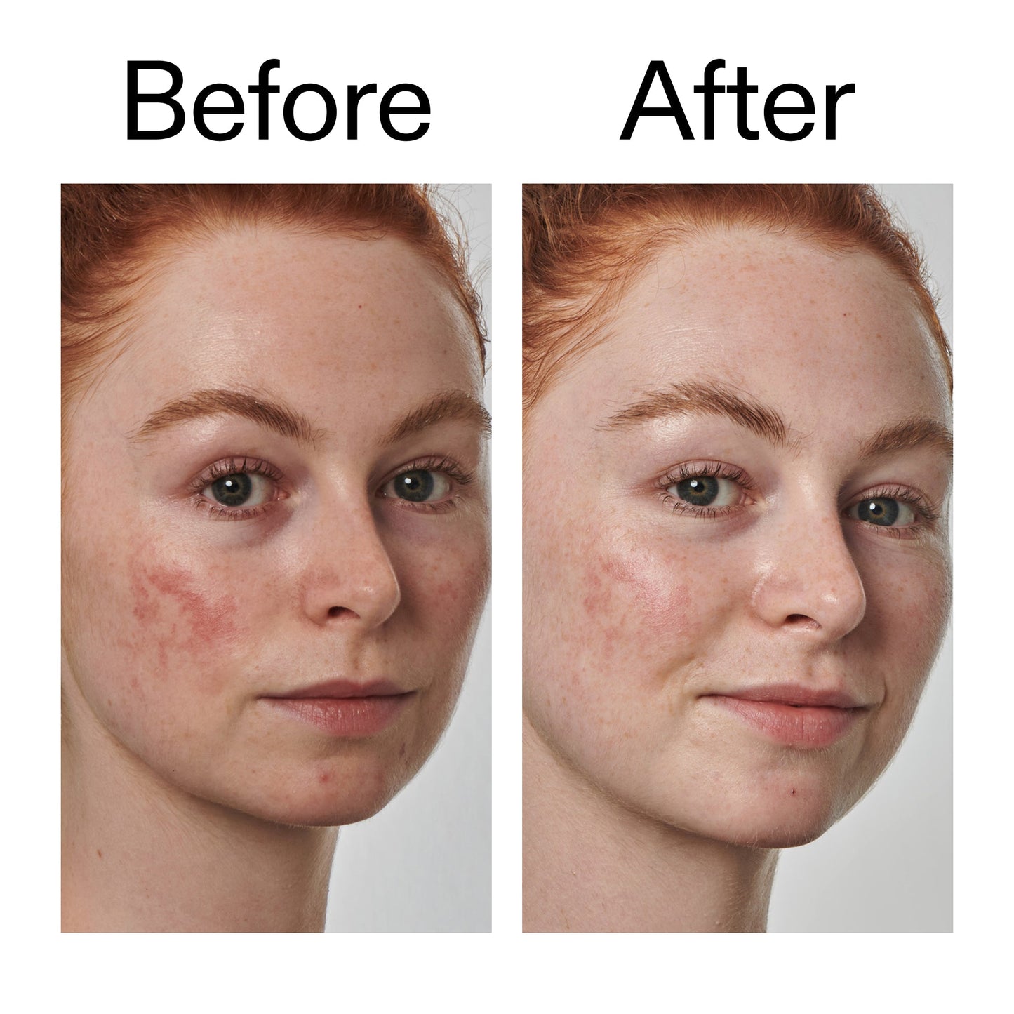 10-azelaic-acid-serum-for-redness-relief-w6 Redness_Relief_Serum_Before_After_2000x2000_3334dc9a-cce9-4e00-8aec-7ad89ca051f2.jpg