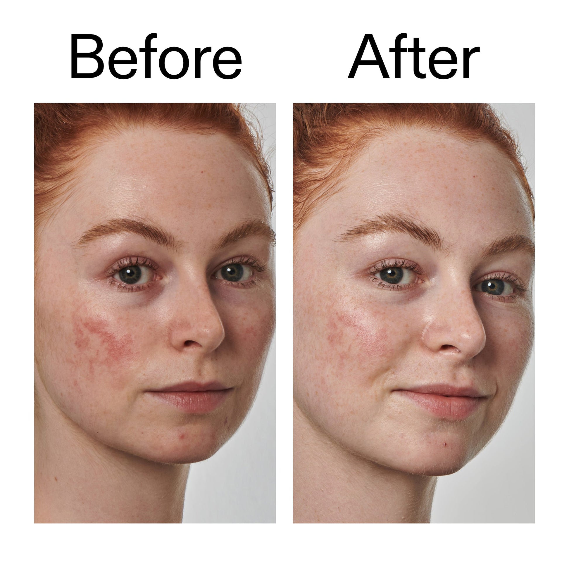 10-azelaic-acid-serum-for-redness-relief-w6 Redness_Relief_Serum_Before_After_2000x2000_3334dc9a-cce9-4e00-8aec-7ad89ca051f2.jpg