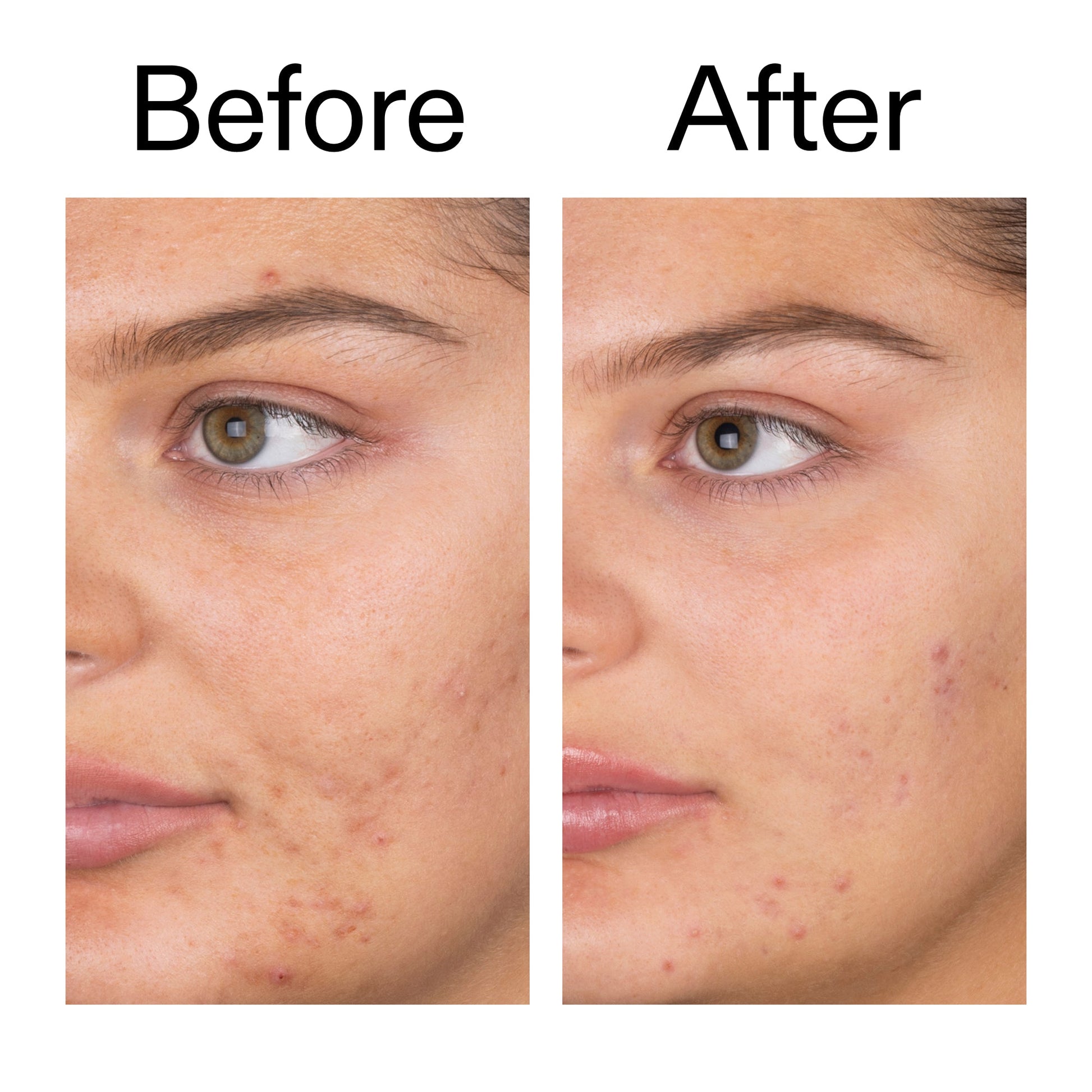 salicylic-acid-cleanser-150ml-n9 Salicylic_Acid_Cleanser_-_150ml_Before_After_2000x2000_e7230494-853f-4b07-82b1-27669104c995.jpg