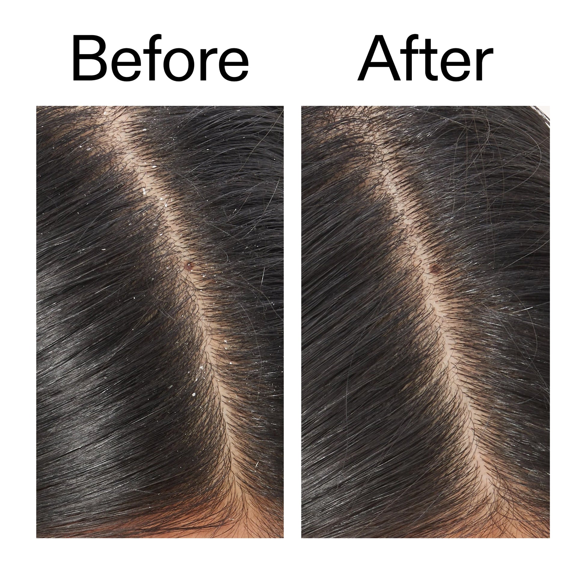 salicylic-acid-exfoliating-scalp-treatment-k9 Salicylic_Acid_Exfoliating_Scalp_Treatment_Before_After_V2_2000x2000_02bd61ad-42bf-490b-b3e3-7e04b2e8a673.jpg