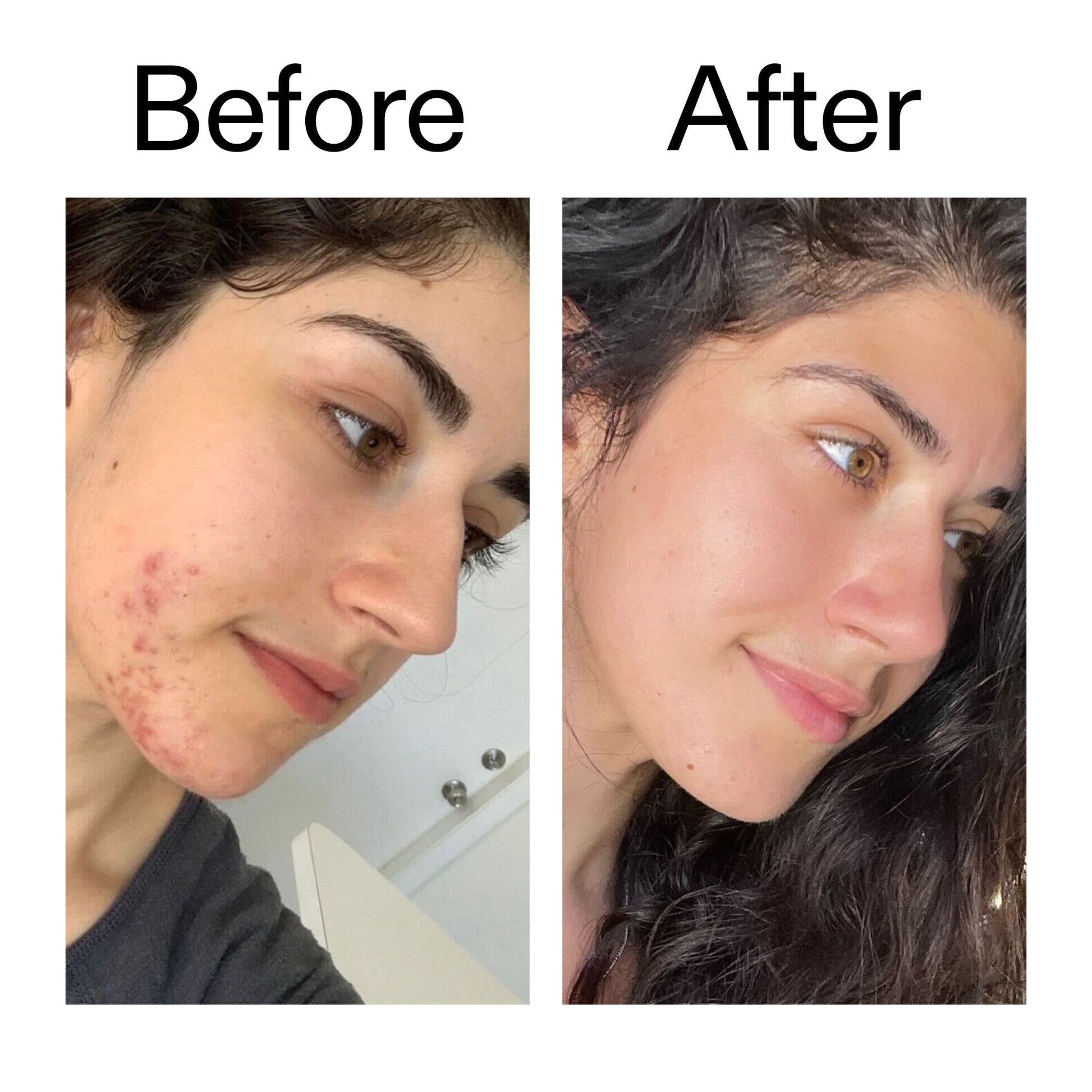 succinic-acid-acne-treatment-m1 Succinic_Acid_Treatment_Before_After_2000x2000_6a5f0054-2f58-4433-9314-0dc72c9bdd3b.jpg