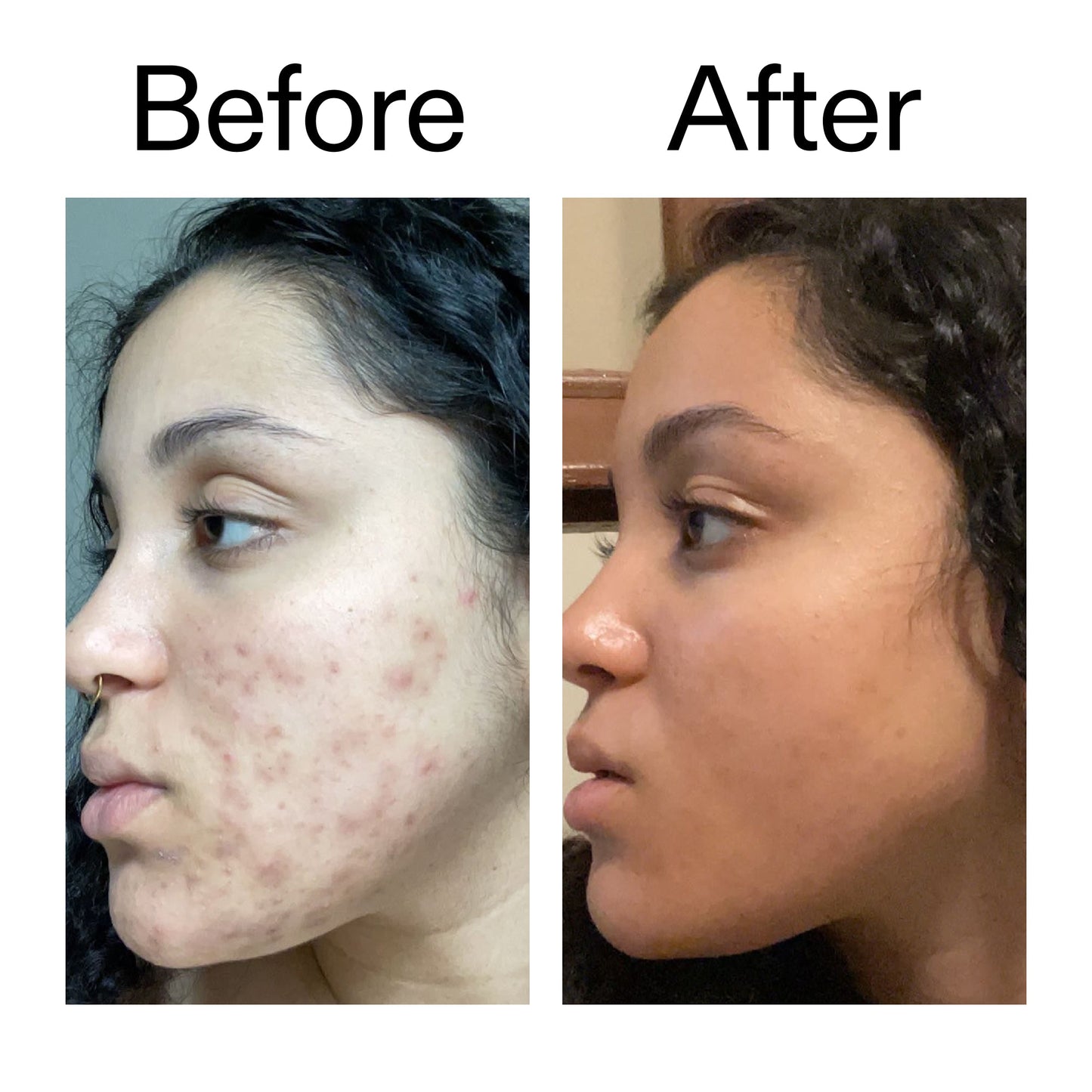 tranexamic-acid-serum-b7 Tranexamic_Acid_Serum_Before_After_2000x2000_98ebc8be-77b0-4843-8a22-90790ebe918b.jpg